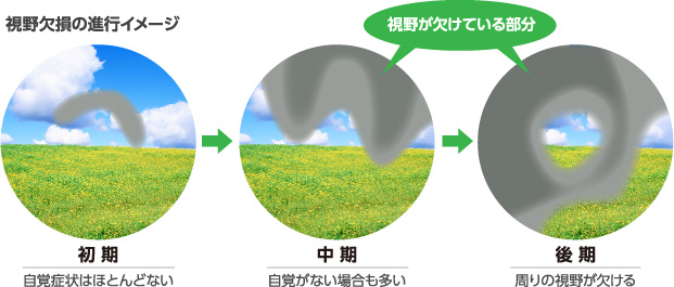 視野欠損の進行イメージ